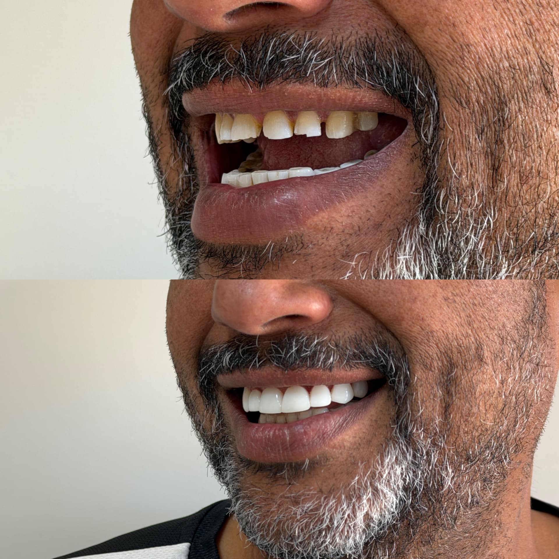 Comparação do sorriso de um paciente antes e após reabilitação dentária